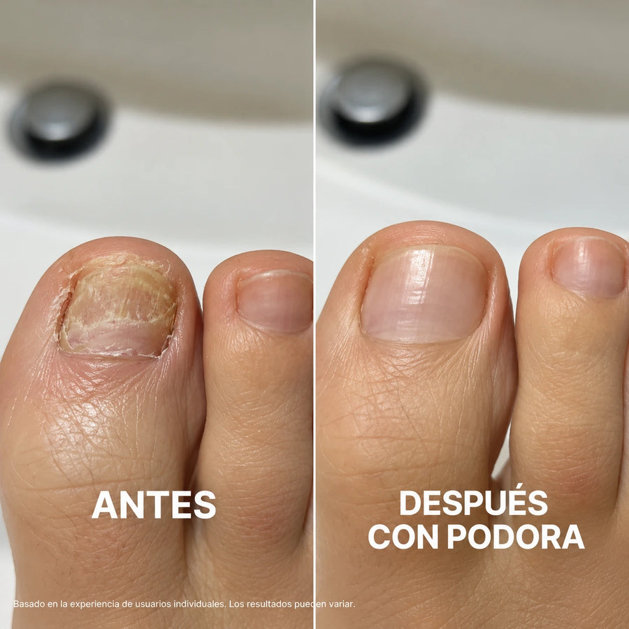 Mi médico quería recetarme Terbinafina. Me negué. Esto lo solucionó.