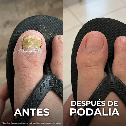 Podalia™ · Lápiz antifúngico de máxima potencia (25 % de ácido undecilénico)
